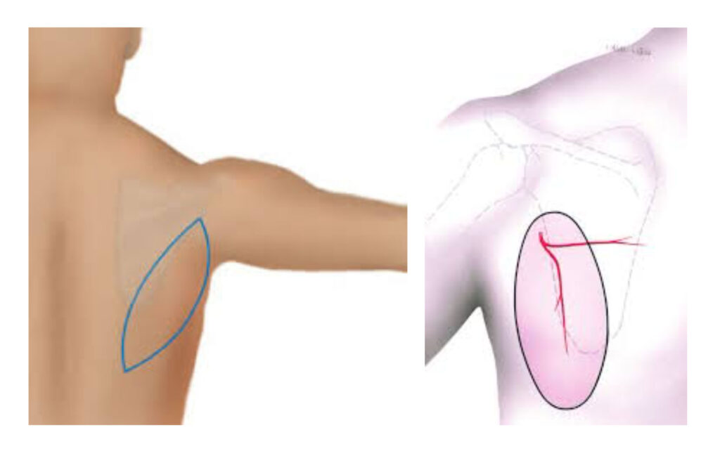 Free-Scapula-flap-Image-1.jpg