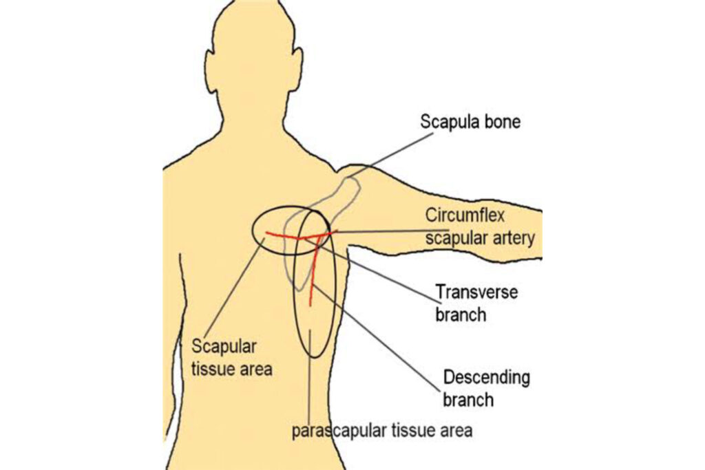Free-Scapula-flap-Image-3-1.jpg